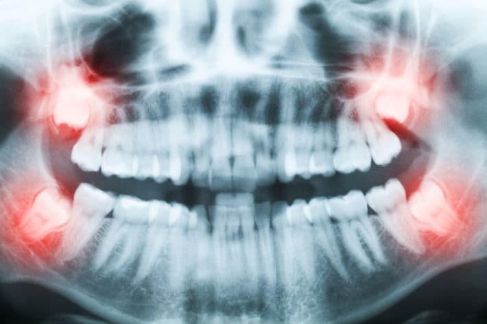 Сколько заживает десна после удаления зуба?