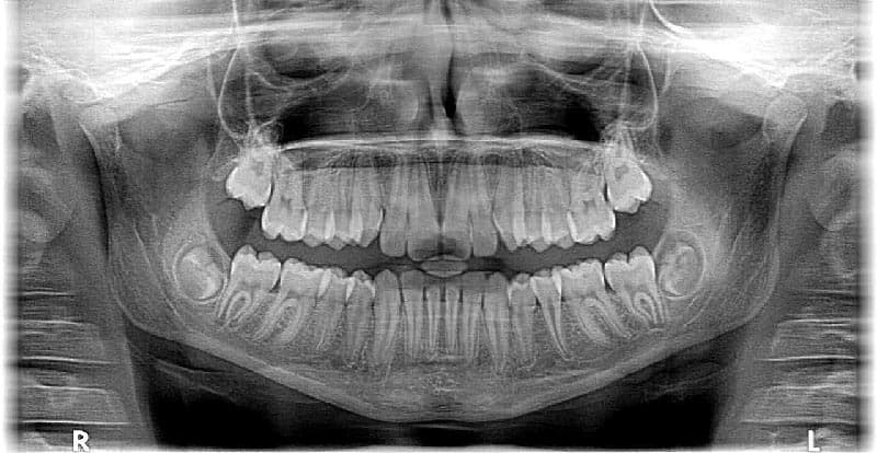 Что такое рентген зубов