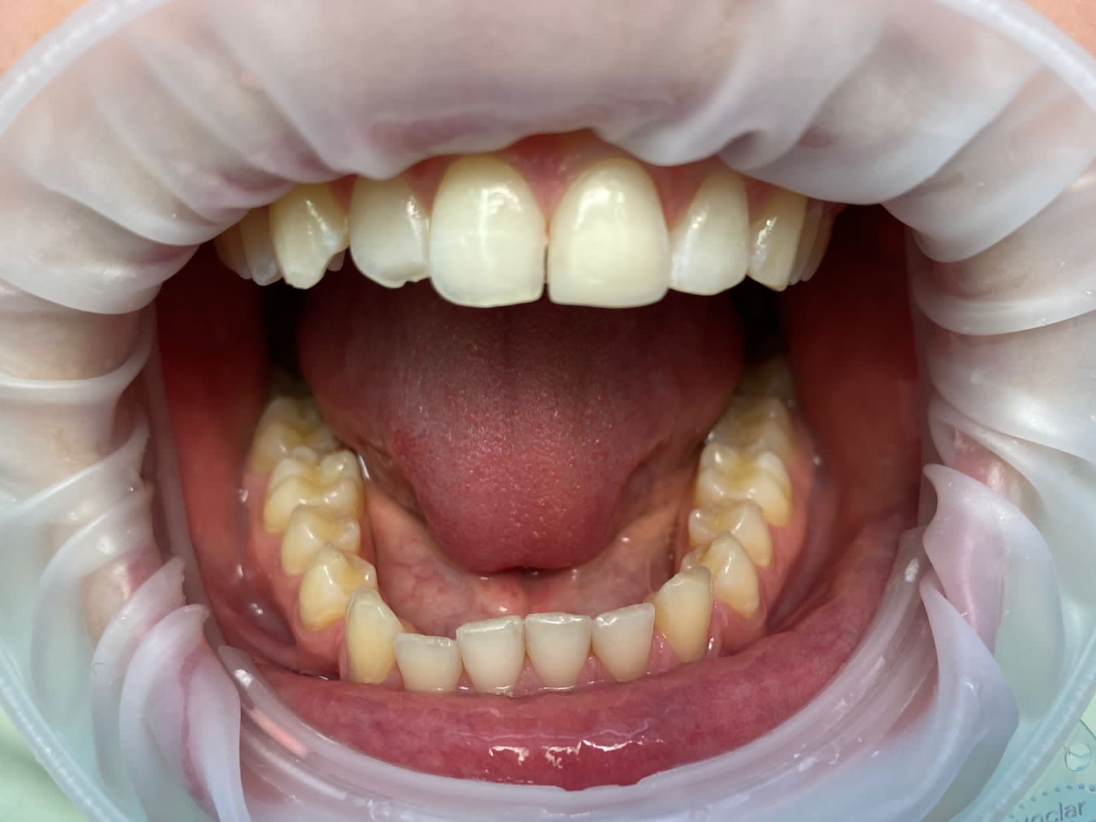 Восстановление скола 21 зуба после травмы