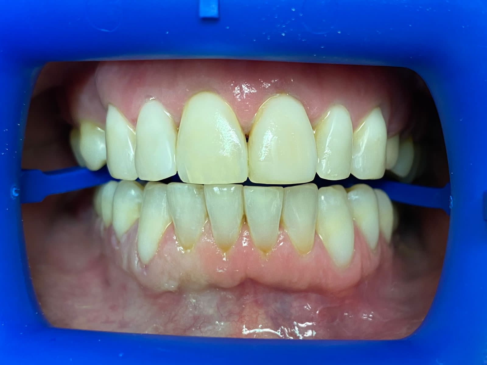 Профессиональная гигиена зубов и замена реставраций