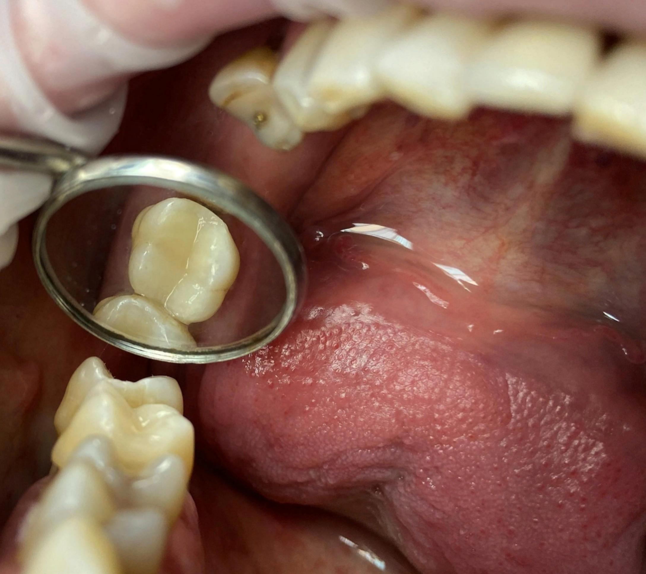 Лечение глубокого кариеса на 27 зубе