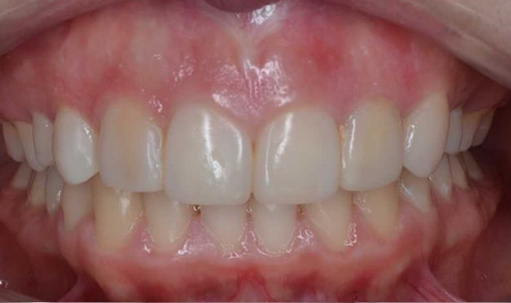 Лечение глубокого дистального прикуса с адентией 12 зуба