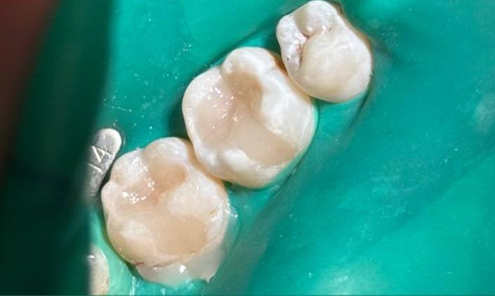 Лечение кариеса