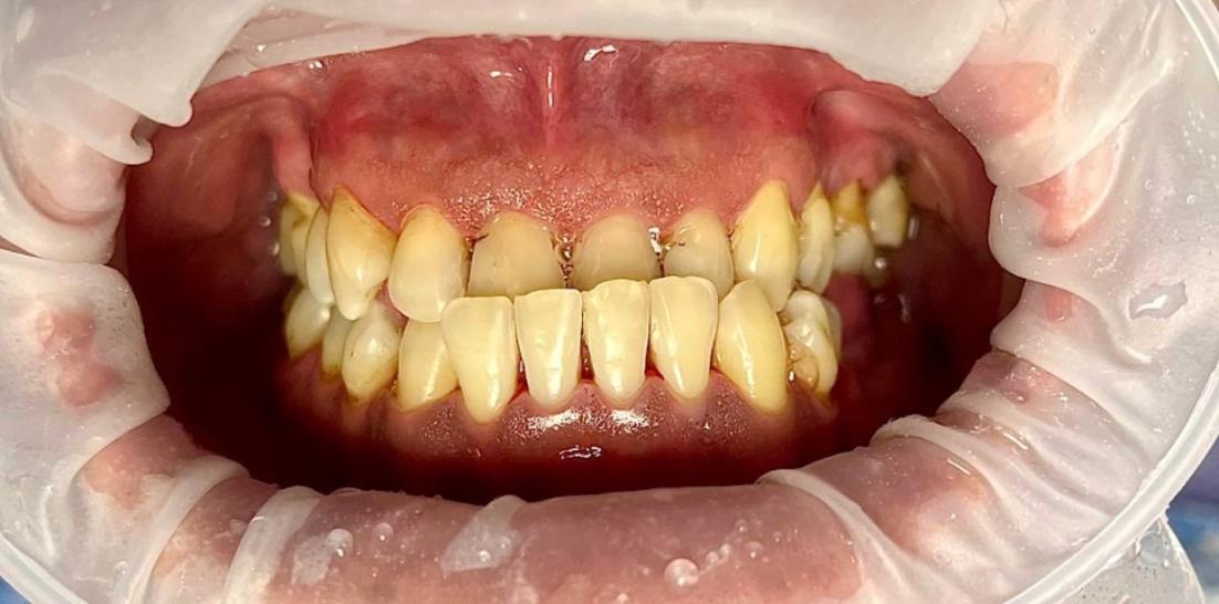 Профессиональная гигиена полости рта 