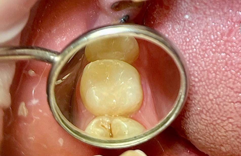 Лечение кариеса