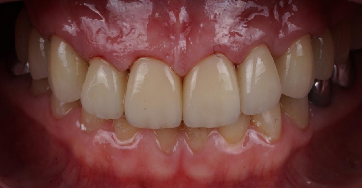Комплексное лечение зубов: терапевтическое и эндодонтическое, удаление с последующей имплантацией