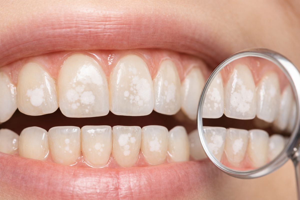 Откуда берутся белые пятна на эмали