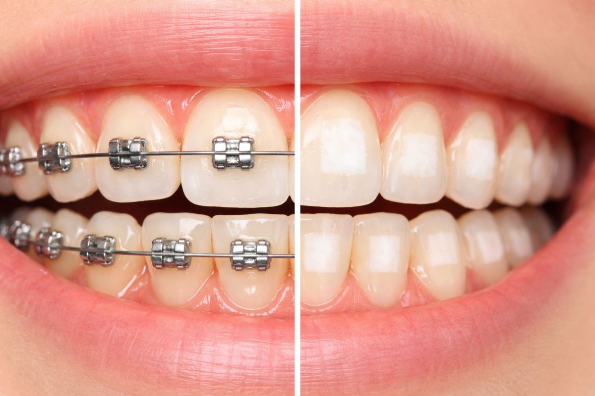 Белые пятна после брекетов и отбеливания