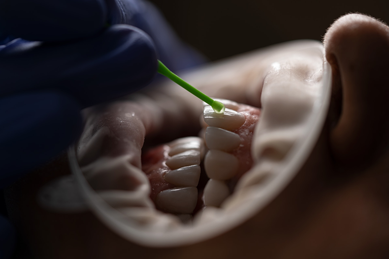Удаление зубного налета завершается реминерализацией, фото