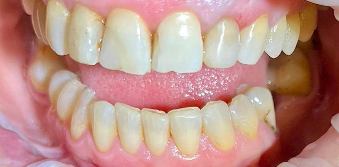 Профессиональная гигиена полости рта 