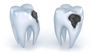 Кариес на поздних стадиях