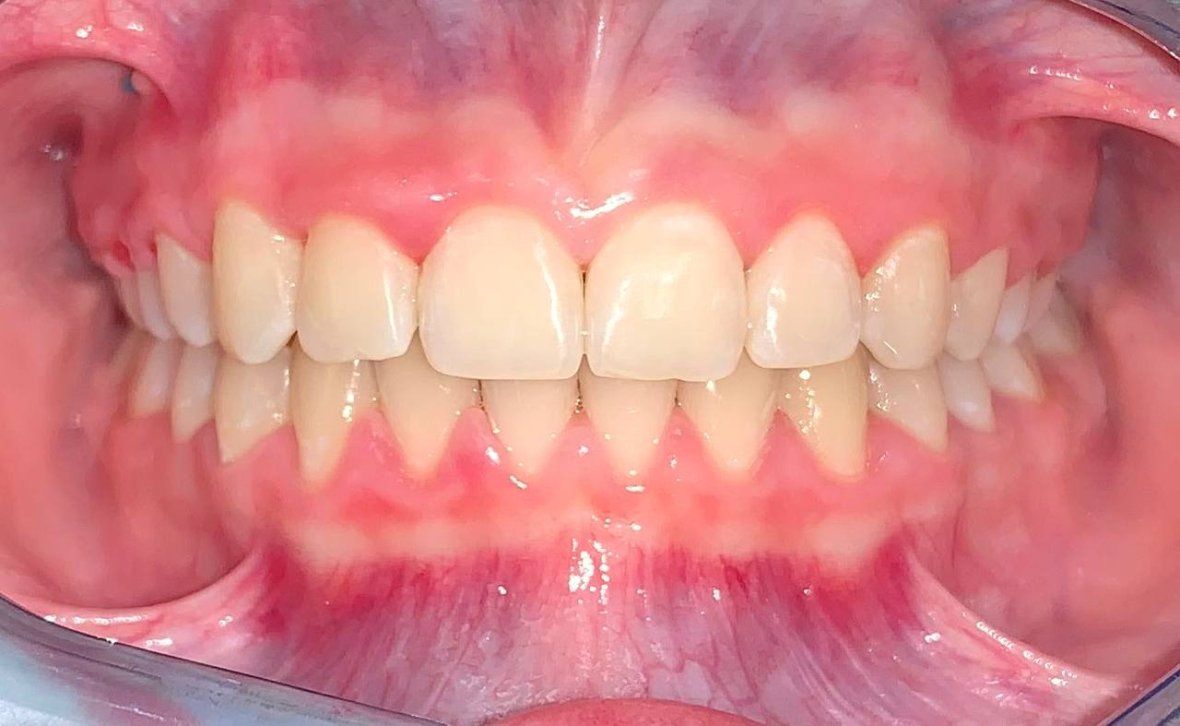 Лечение глубокого прикуса  