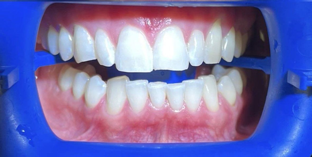 Отбеливание ZOOM 4