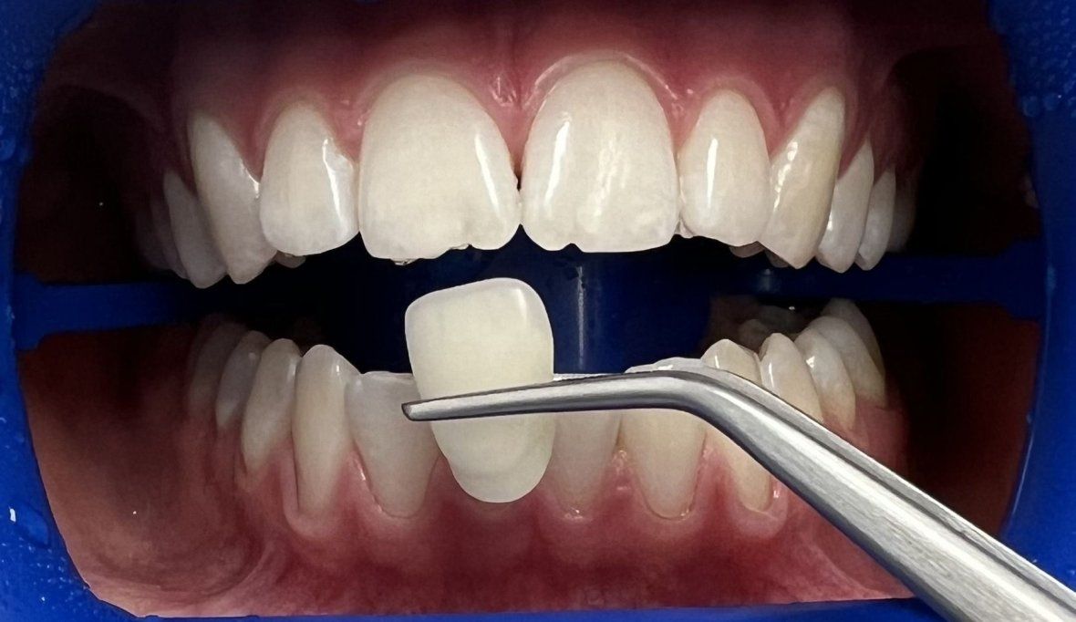 Отбеливание ZOOM 4