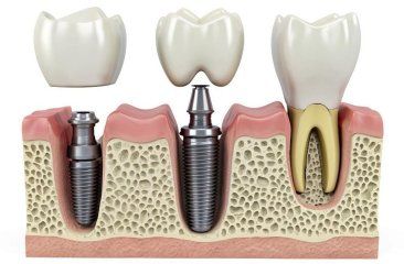 Отторжение зубного импланта: причины и симптомы, как это происходит?