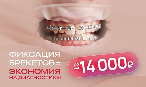 Фиксация брекетов = экономия до 14 000₽ на диагностике!