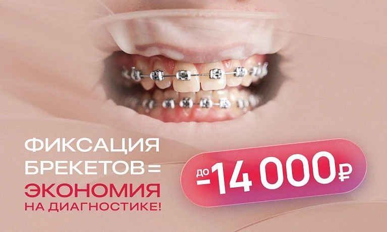 Фиксация брекетов = экономия до 14 000₽ на диагностике!