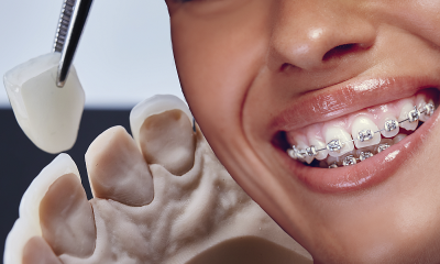 Можно ли ставить брекеты на виниры