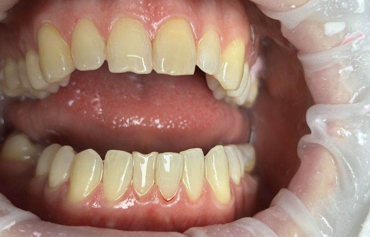 Профессиональная гигиена полости рта