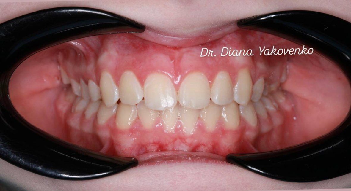 Лечение на брекет-системе 