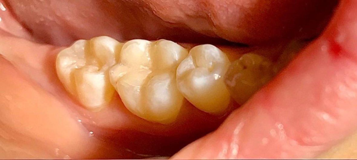 Лечение кариеса